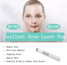 Load image into Gallery viewer, Heath Blue Light Therapy Varicose Veins Treatment Laser Pen Soft Scar Wrinkle Removal Treatment Acne Laser Pen Massage Relax